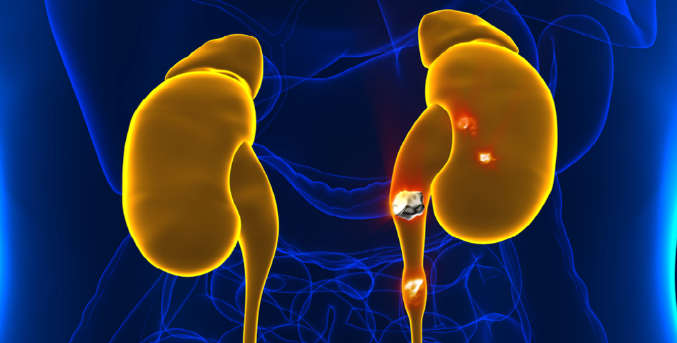 Kidney Stones, The Top 6 Things You Should Know About ...