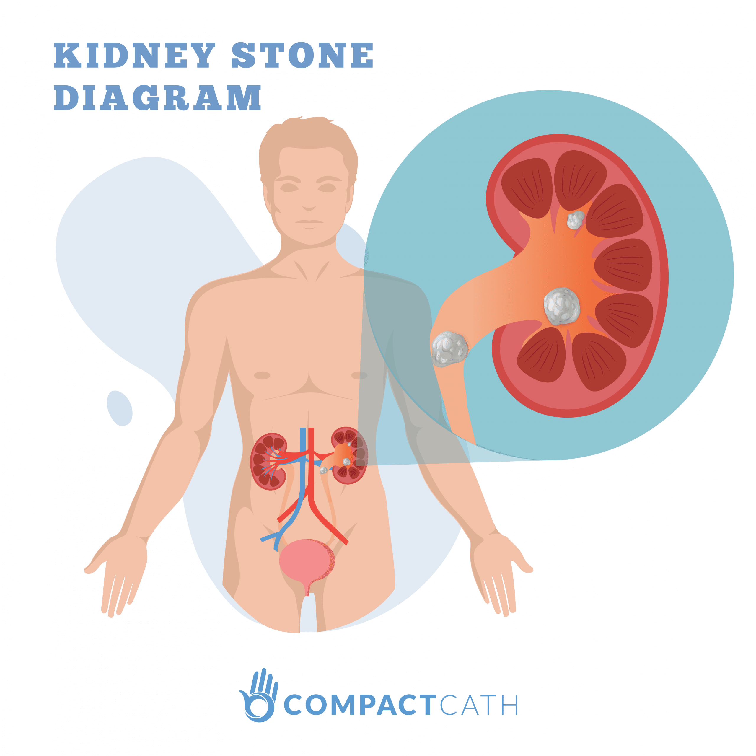 Kidney Stones: The Ultimate Beginnerâs Guide