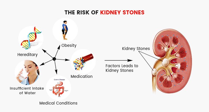 Kidney Stones Treatment in Vijayawada