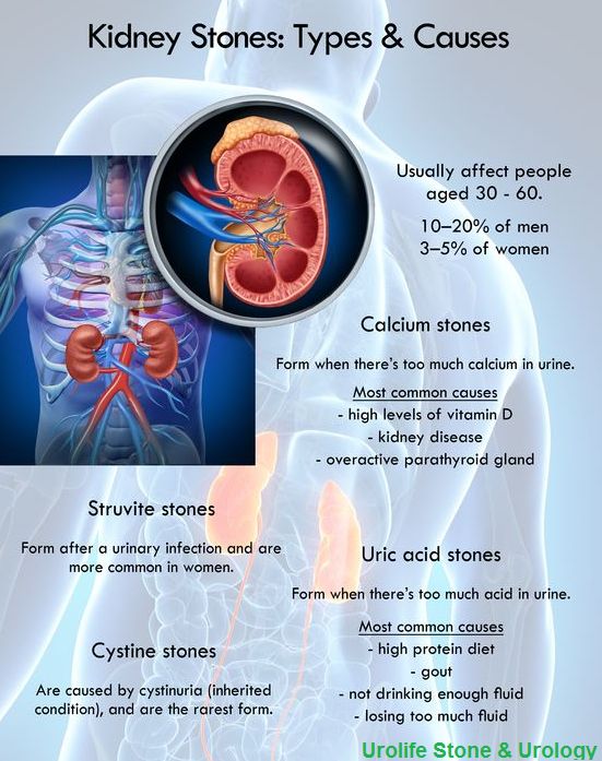 Kidney Stones: Types &  Causes