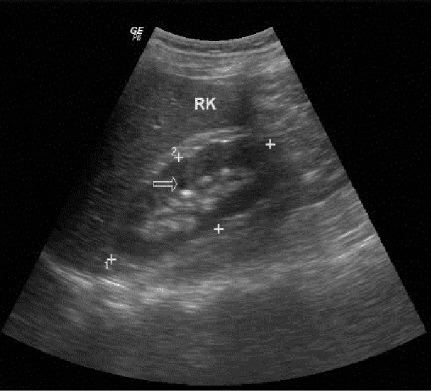 can-renal-ultrasound-detect-kidney-stones-healthykidneyclub