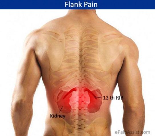 Kidney Stones Vs Back Pain