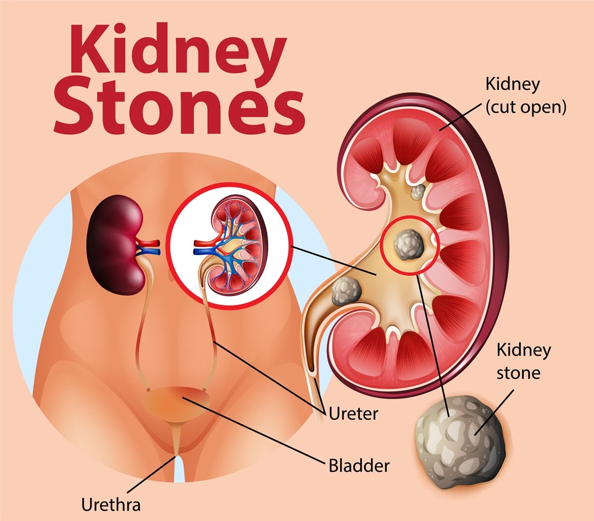 Kidney Stones: What Do You Need To Know?
