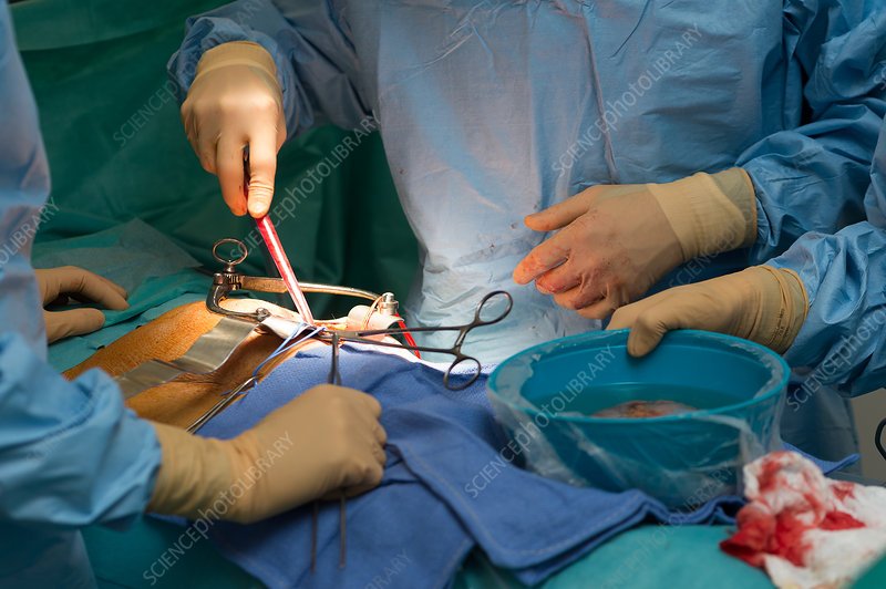 Kidney transplant, France