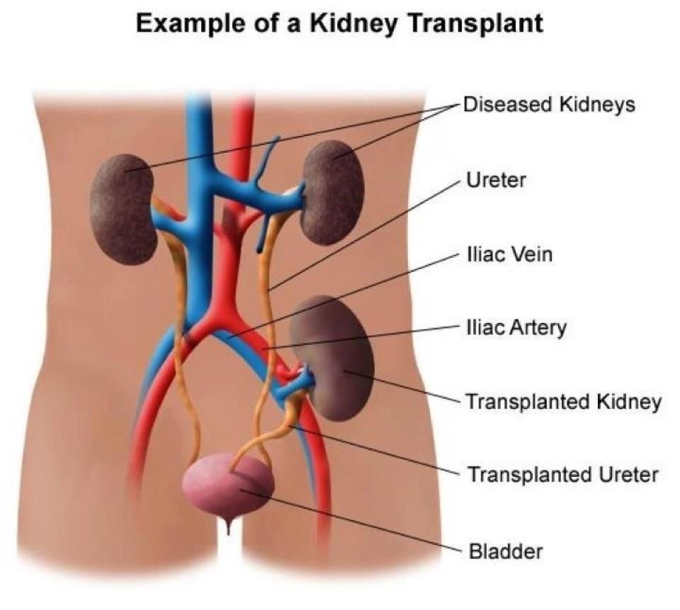 Kidney Transplant location