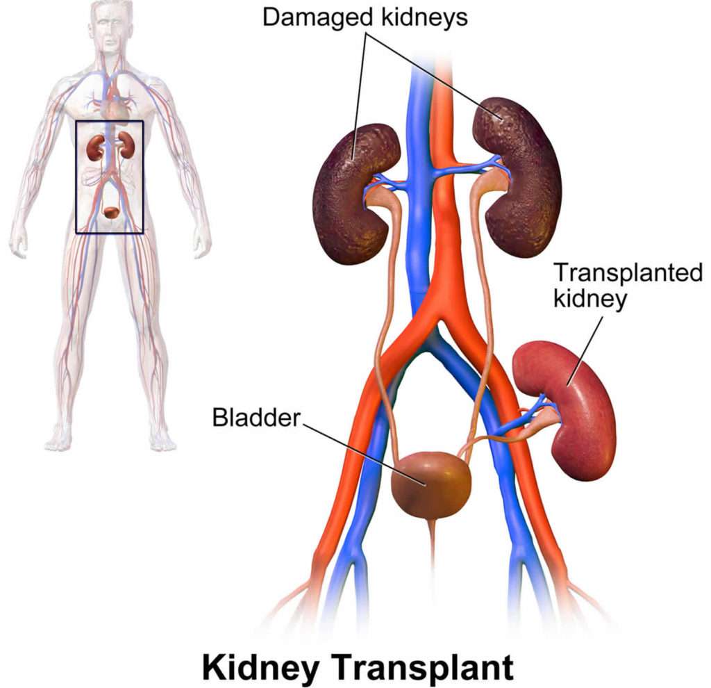 Kidney transplant process, procedure, cost, complications and recovery