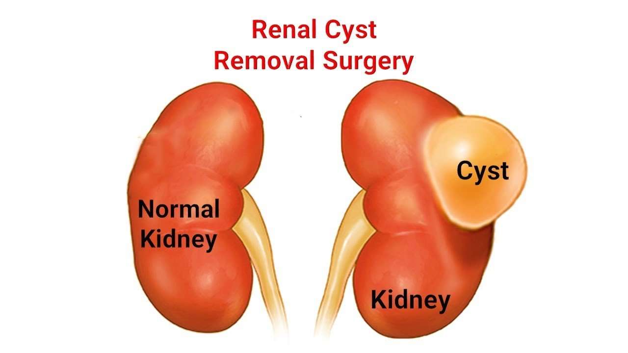 how-to-remove-cyst-from-kidney-healthykidneyclub