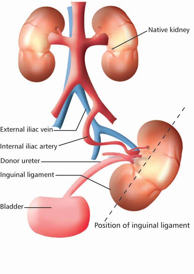 LIVE WITH KIDNEY(RENAL) DISEASE: March 2013