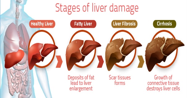 Why Does Liver Disease Cause Bruising