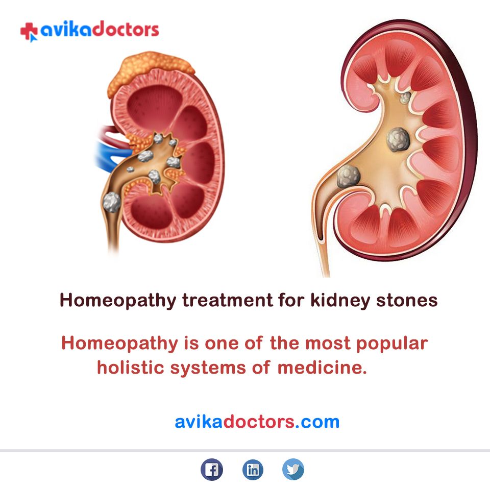 Looking for the best homeopathic medicine for kidney stone removal ...