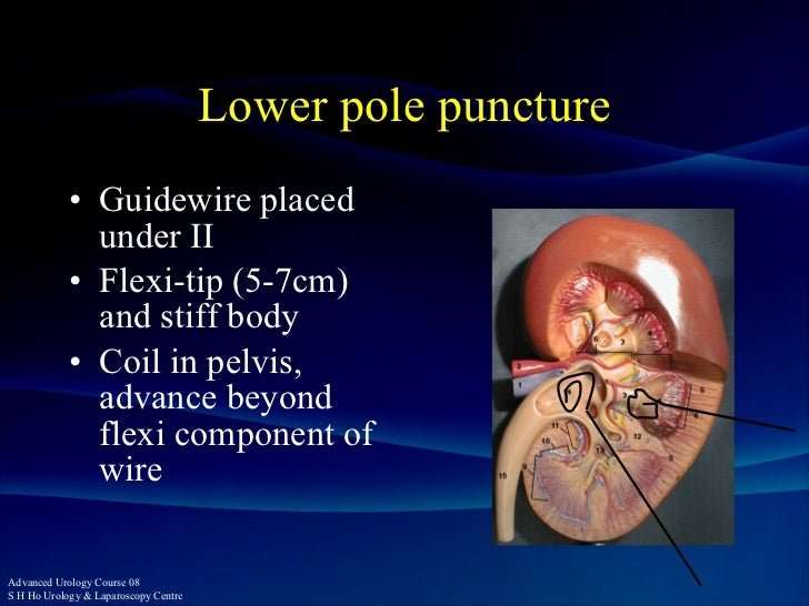 Lower Pole Calyx Kidney Stones
