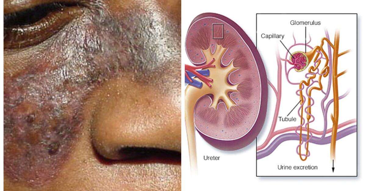 LUPUS FOUNDATION: " The Kidneys are The Most Commonly ...