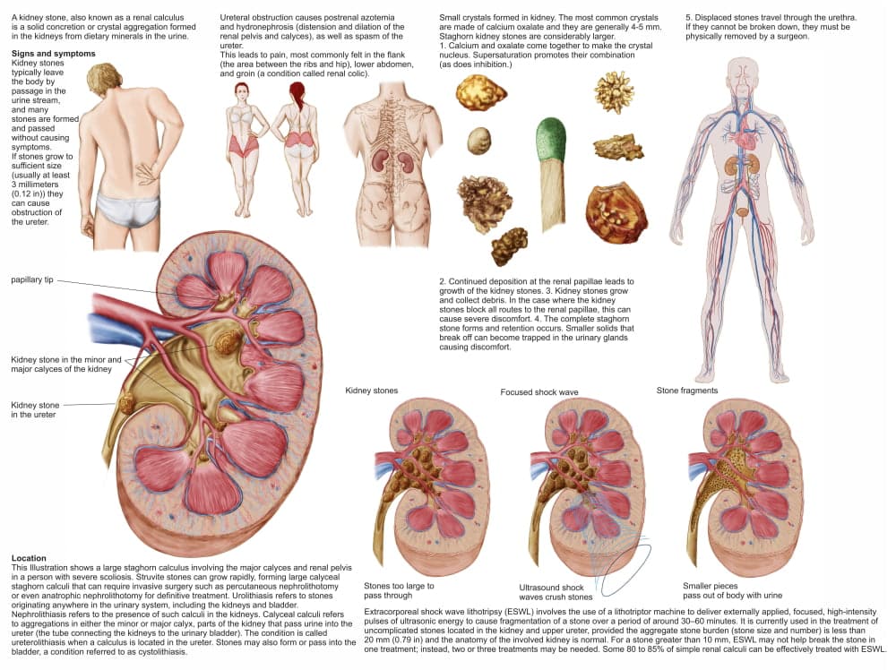 top-10-natural-remedies-for-kidney-stones