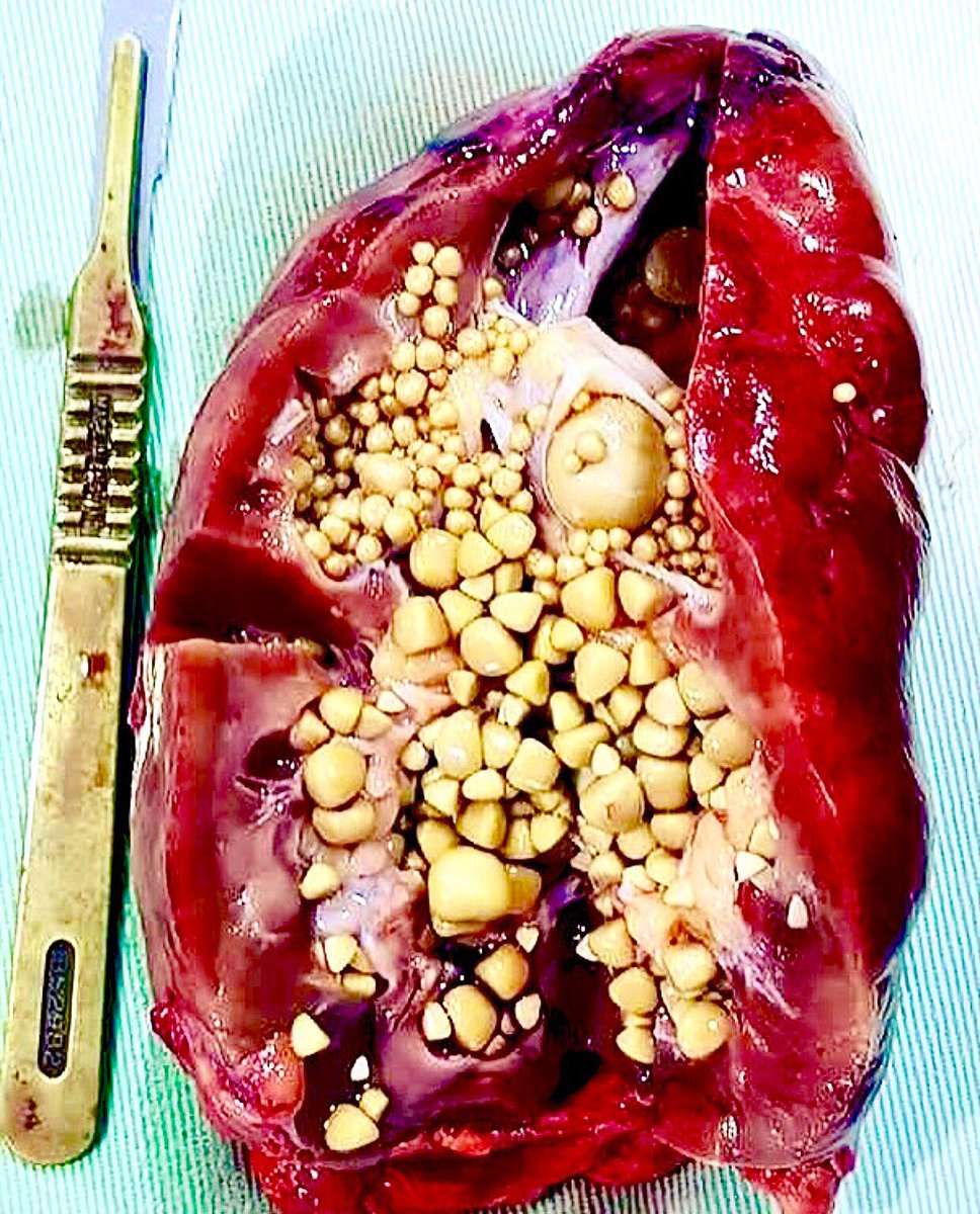 Medical Institution on Twitter: " Kidney full of stones  #kidneystones ...