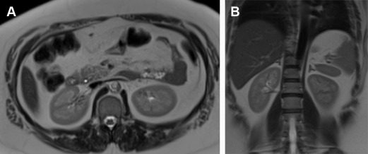 MR Imaging Evaluation of the Kidneys in Patients with Reduced Kidney ...