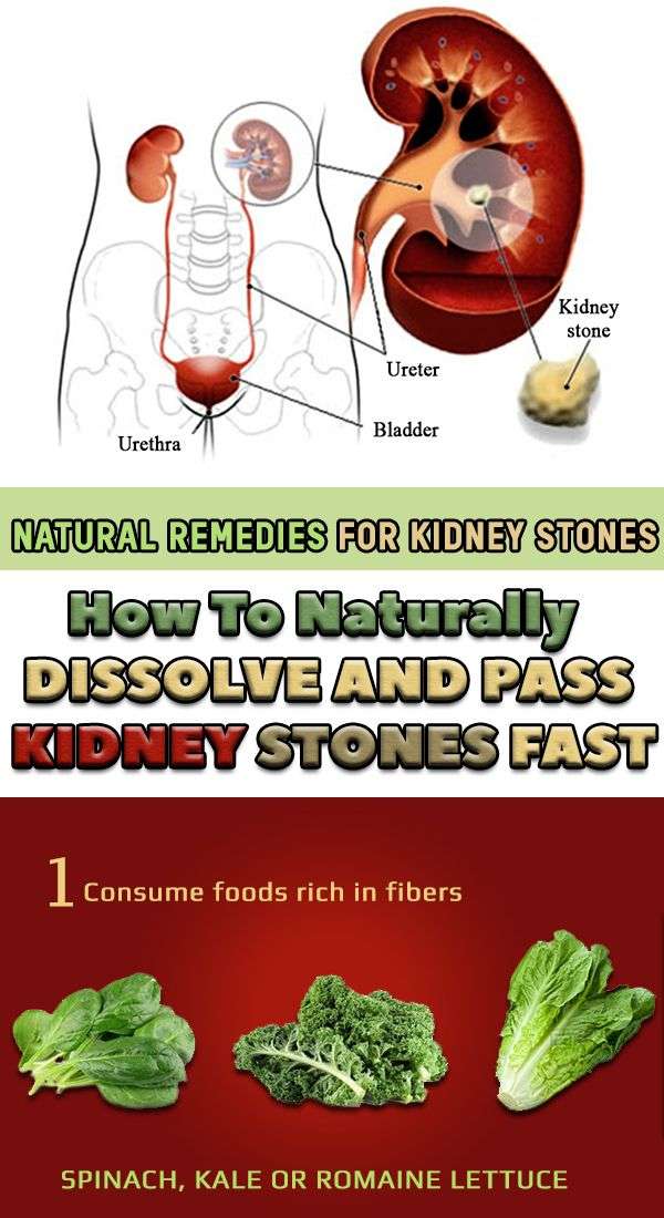 Natural Remedies for Kidney Stones ! How to Naturally DISSOLVE AND PASS ...