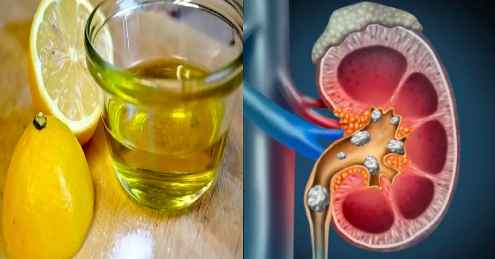 what-dissolves-kidney-stones-fast-healthykidneyclub