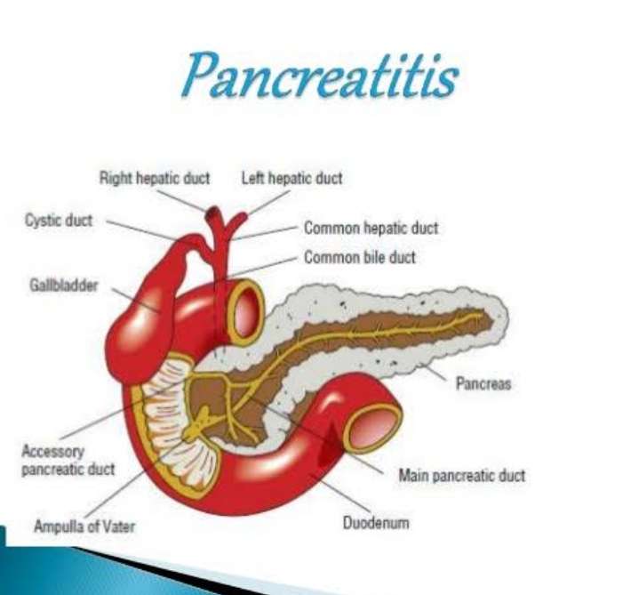 Pancreatitis â NandiniDoctors