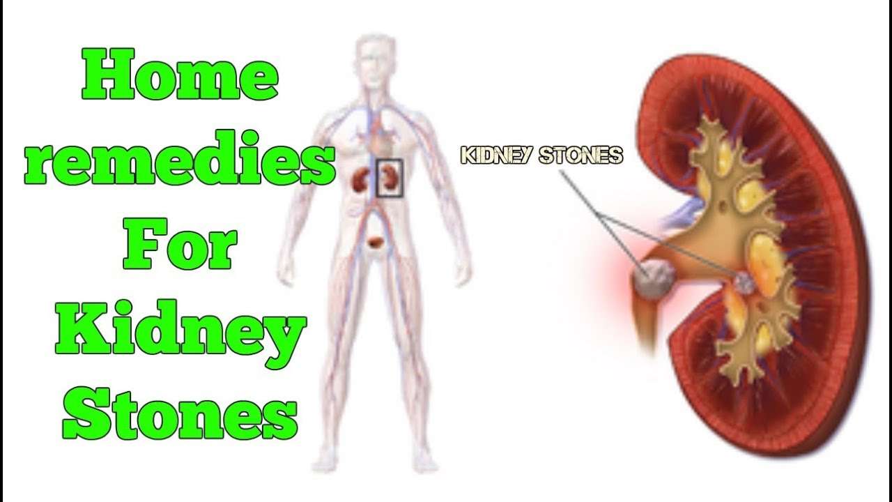 Pass Kidney Stone Quickly With Home Remedies
