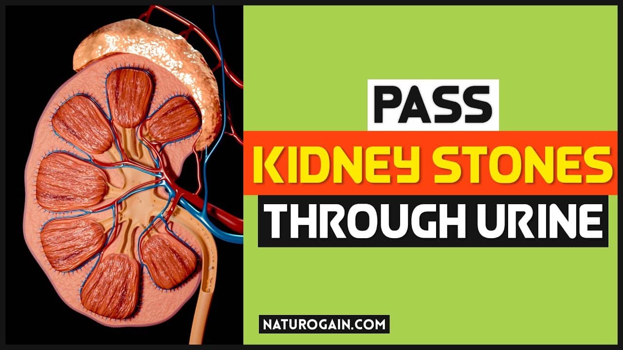 Pass Kidney Stones Through Urine Without Pain, Surgery Naturally At ...