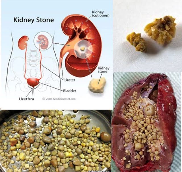 Passing A Kidney Stone Female