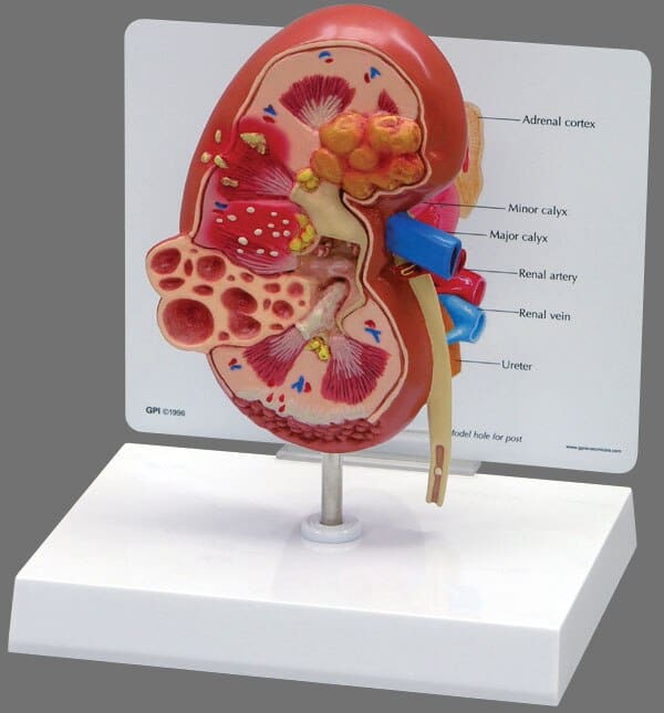 Pathological model of kidney disease models, models of kidney stones ...