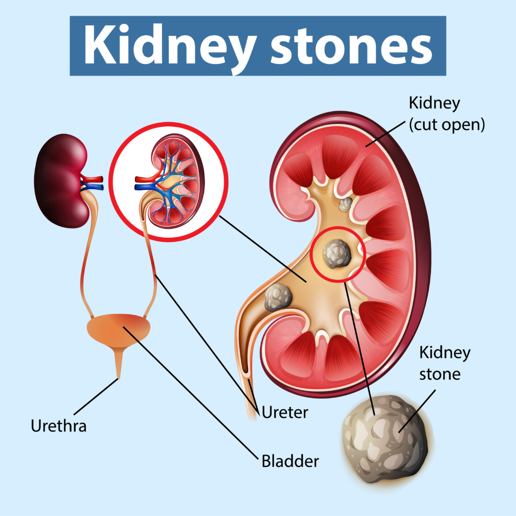 PCNL Surgery For Kidney Stone Removal