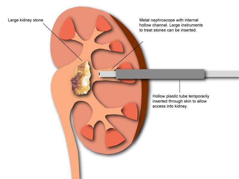 Percutaneous lithotripsy for kidney stones (PCNL ...