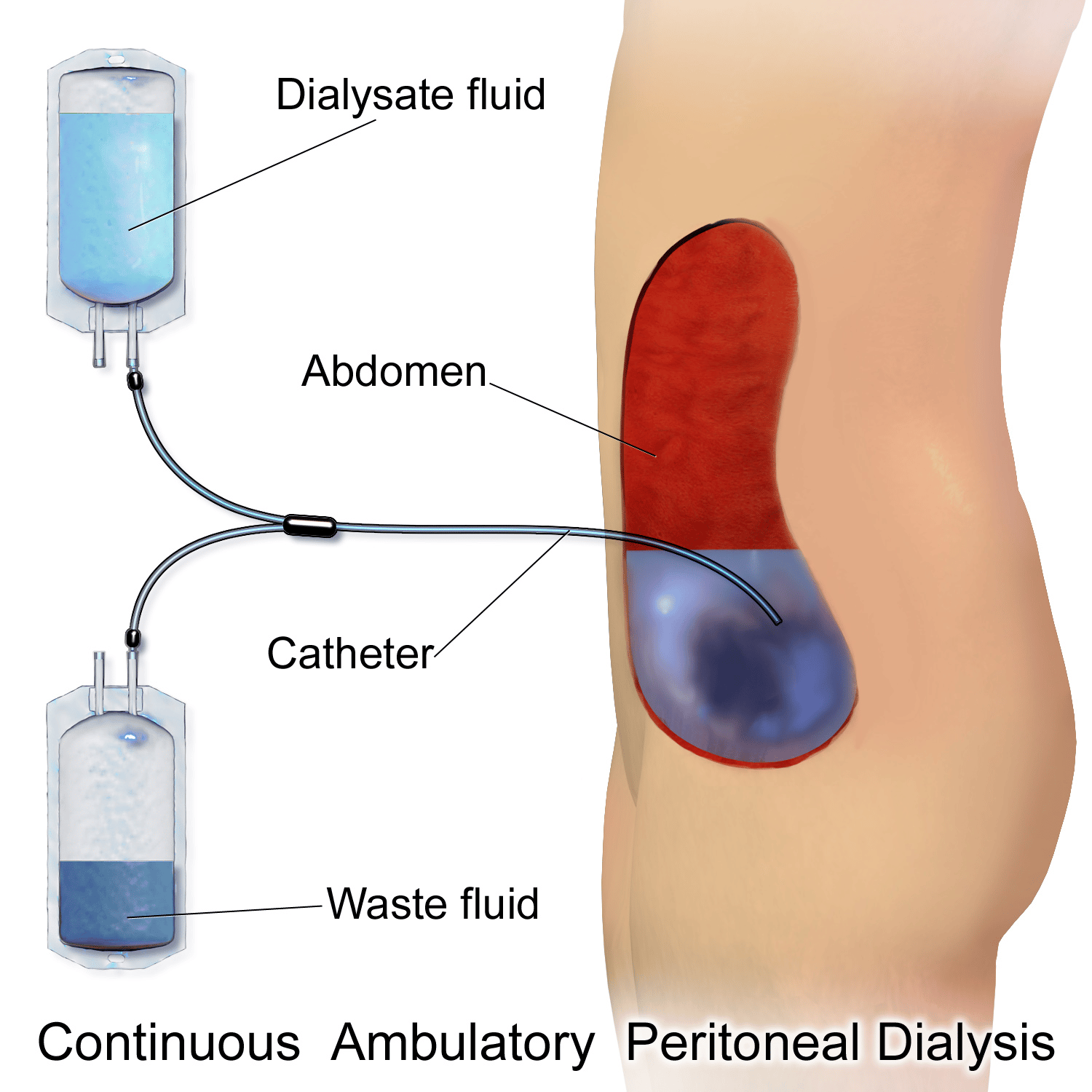 Peritoneal Dialysis in Hyderabad, Bhubaneswar and India