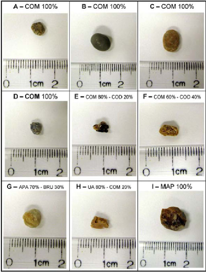 Picture Of 1 Cm Kidney Stone