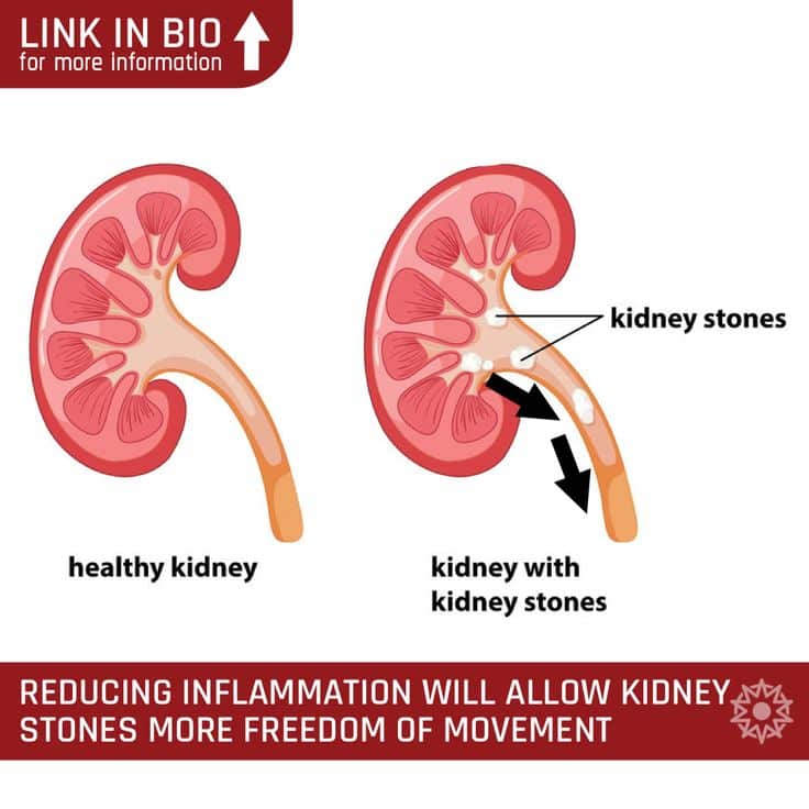 Pin on 4 Keys to Naturally Passing Kidney Stones