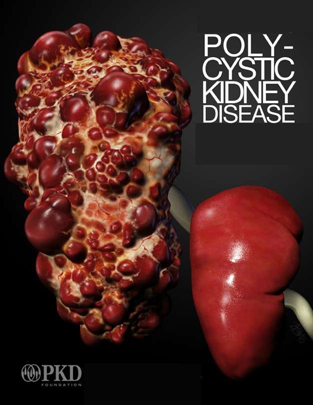 Polycystic Kidney Disease Archives