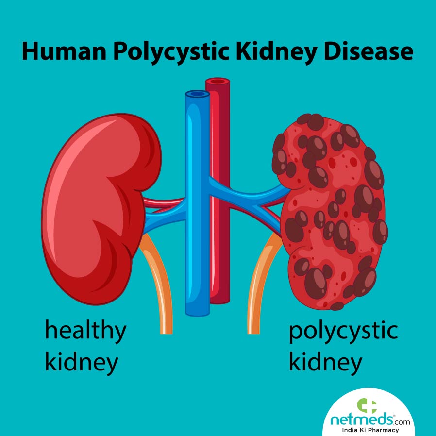 Polycystic Kidney Disease: Causes, Symptoms And Prevention
