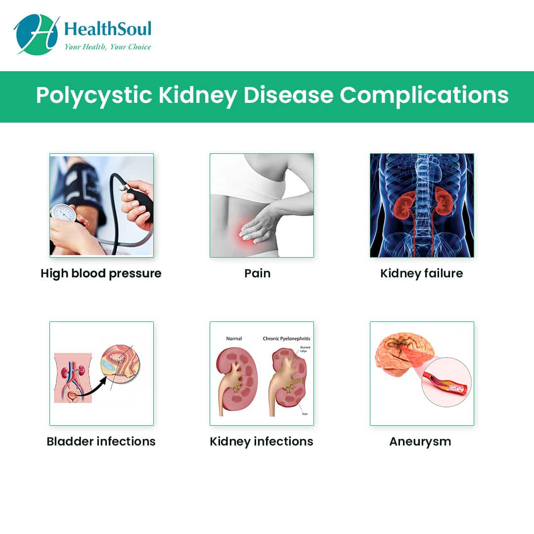 Polycystic Kidney Disease: Symptoms, Diagnosis, and Treatment â Healthsoul