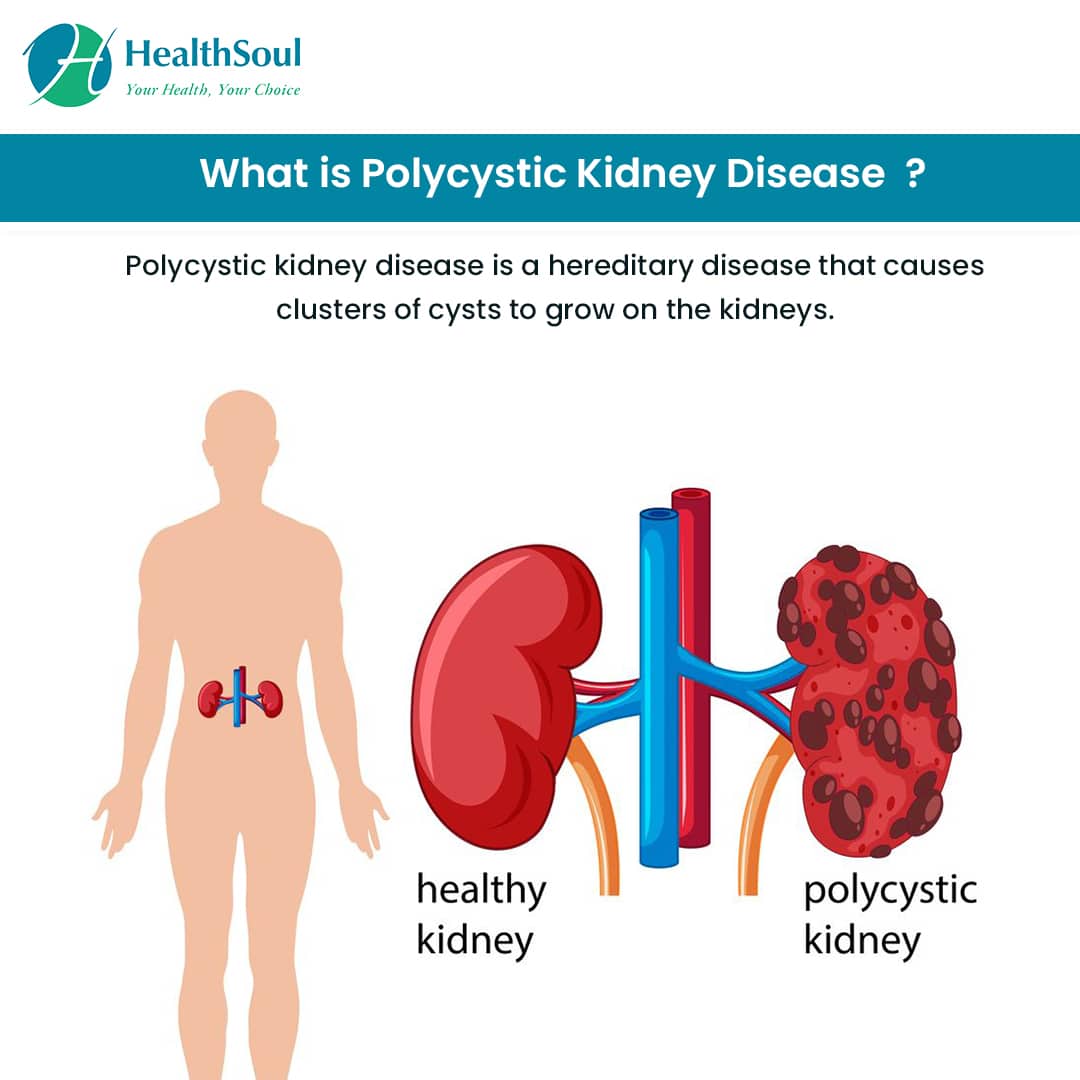 Polycystic Kidney Disease: Symptoms, Diagnosis, and Treatment  Healthsoul