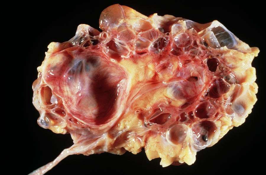 Polycystic Kidney Photograph by Cnri/science Photo Library