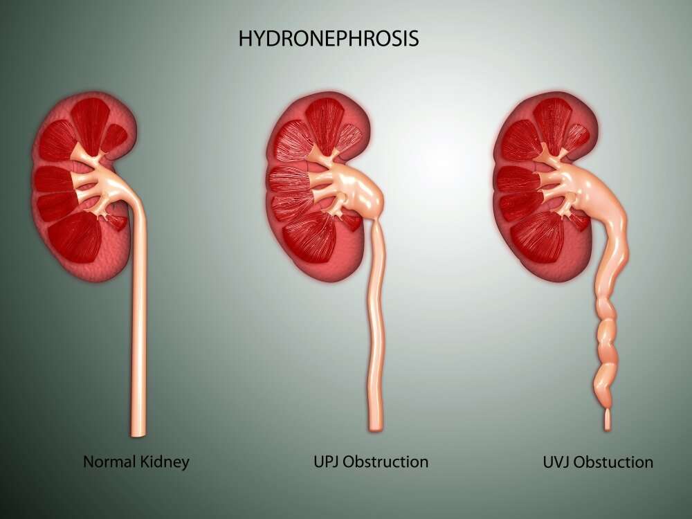 Posterazzi: Hydronephrosis condition of the kidney ...