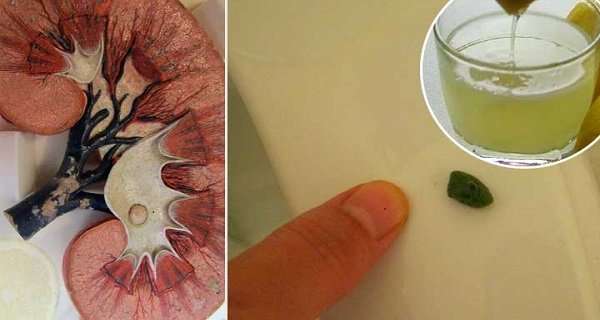Prevent Kidney Stone Formation Or Expel Them Using This ...