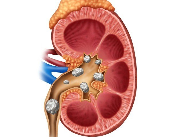 Preventing and Eliminating Kidney Stones