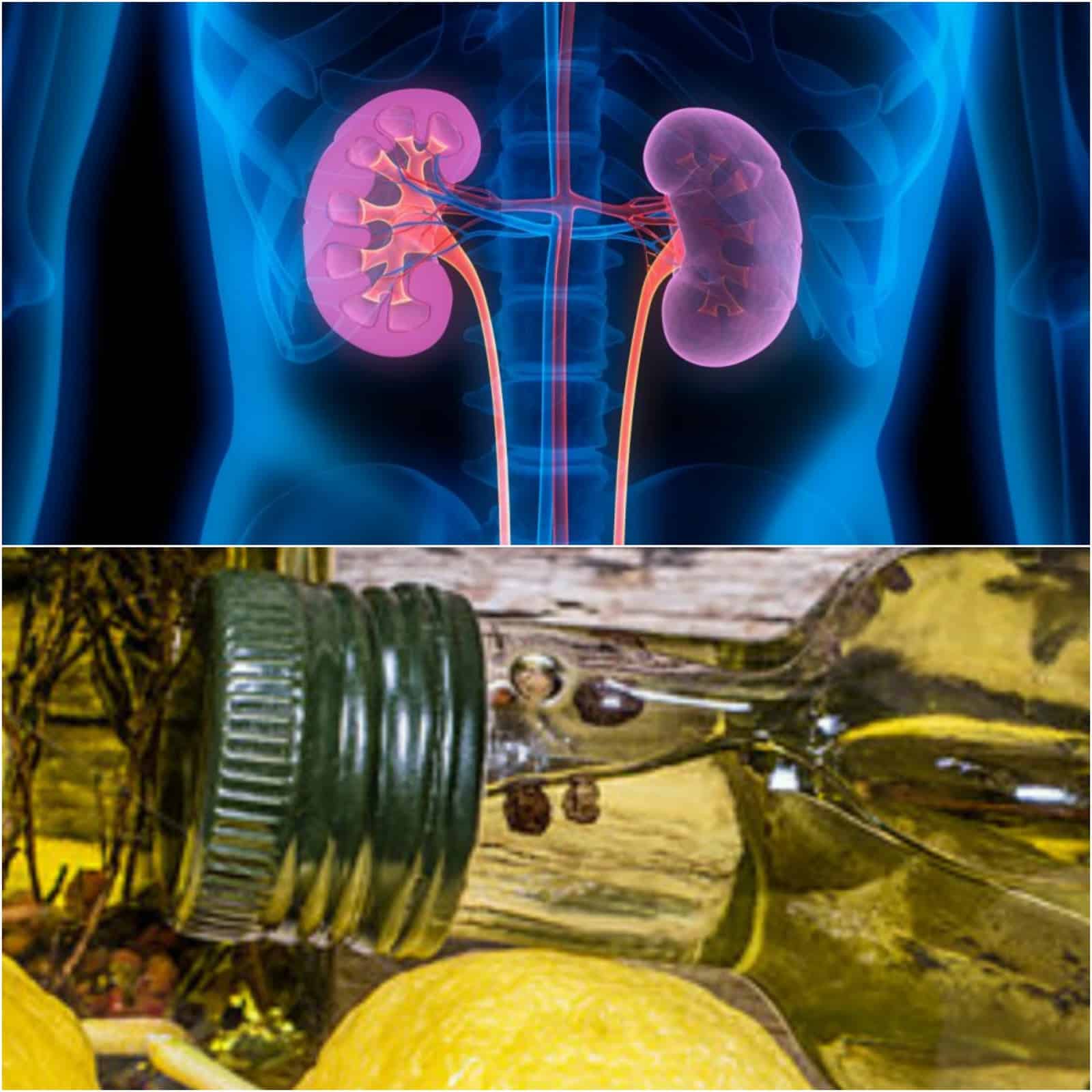 Remove Your Kidney Stones In Only 3 Days With This Traditional Remedy ...