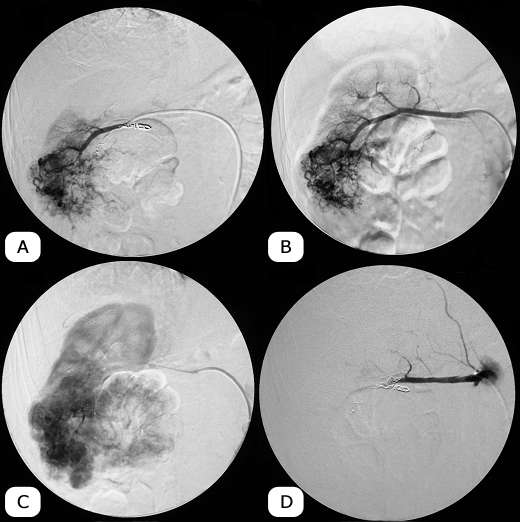 Renal Artery Embolization in Treatment of Renal Cancer with Emphasis on ...