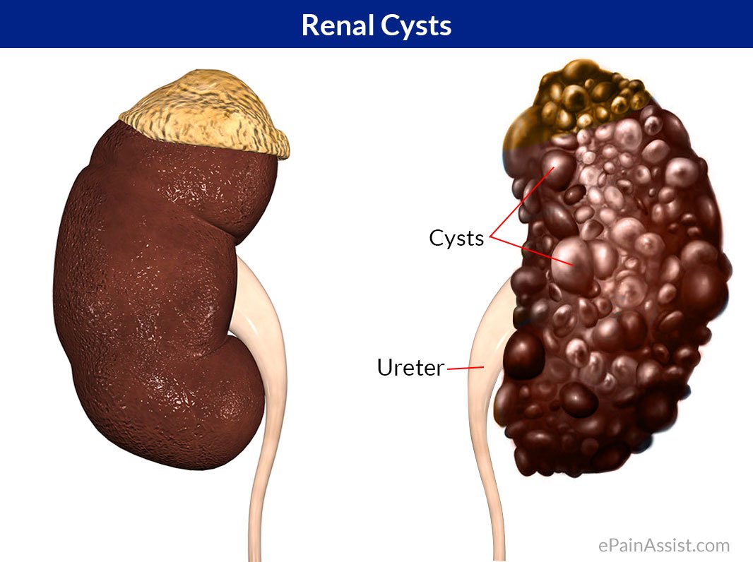 Renal Cysts: Treatment, Complications, Causes, Symptoms