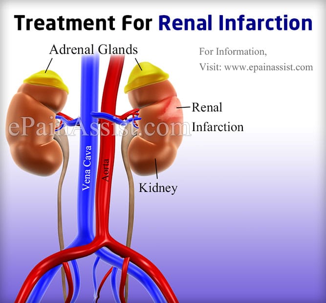 Renal Infarction: Treatment, Causes, Symptoms, Signs
