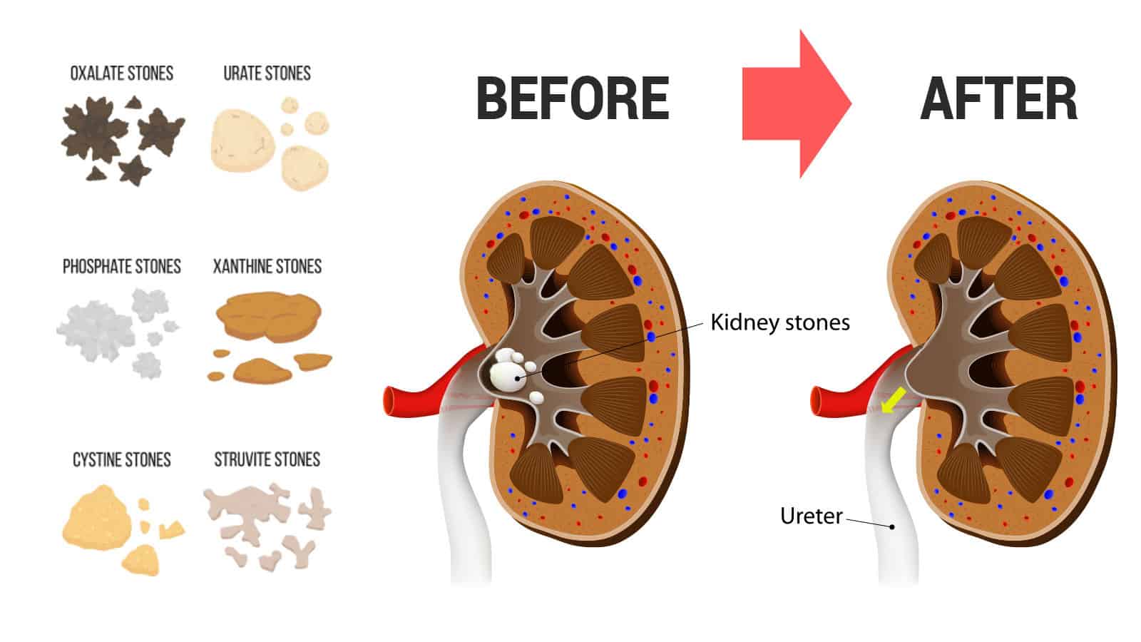 Researchers Reveal New Treatment to Help Flush Kidney Stones