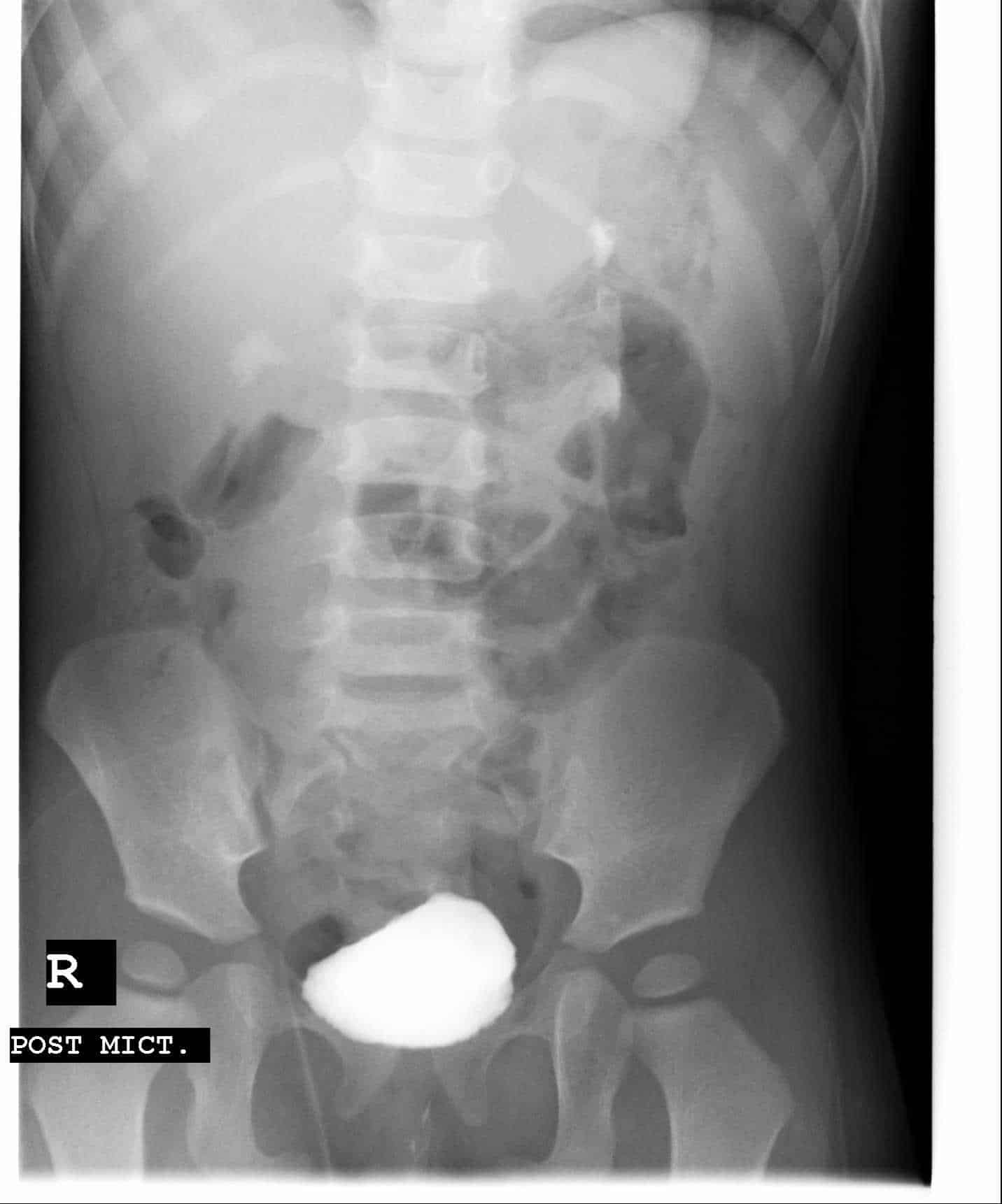 Right Renal Calculus with Bilateral Vesico Ureteric Reflux « Child ...