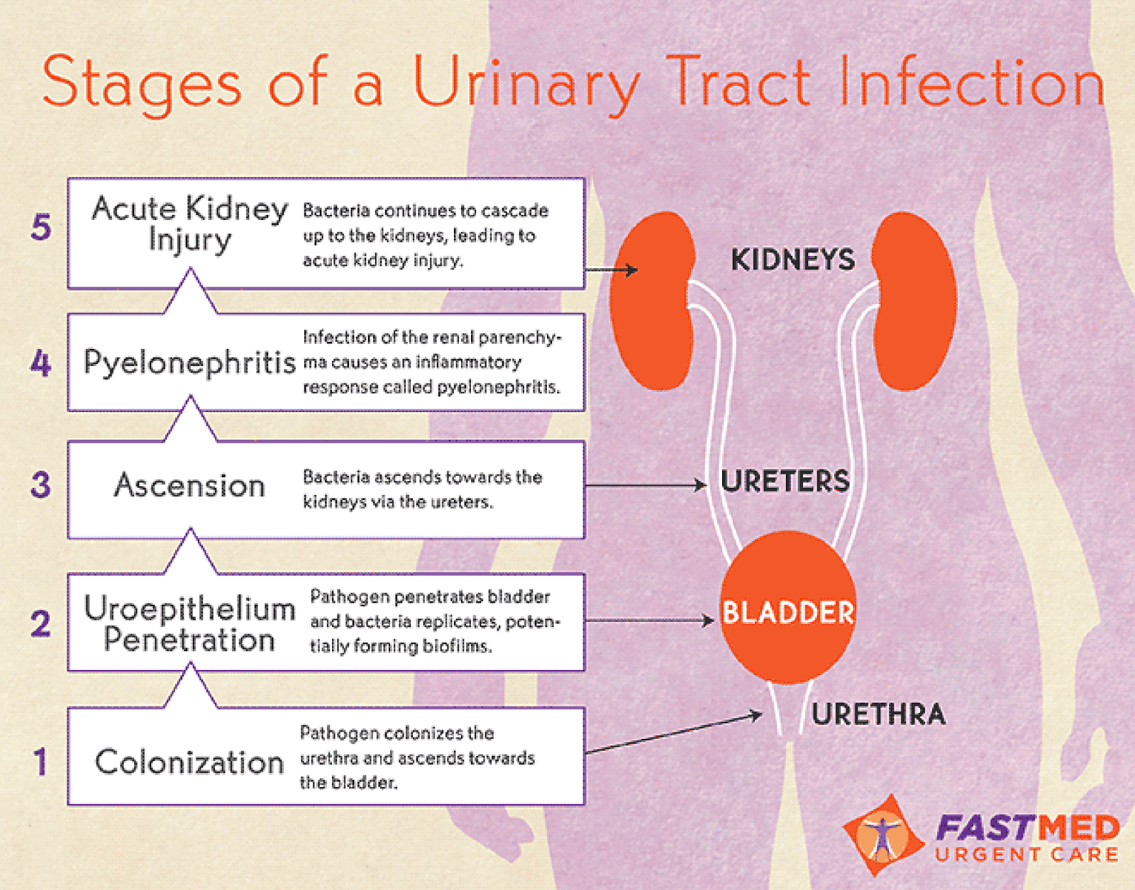 Can You Get A Kidney Infection Without A Uti HealthyKidneyClub