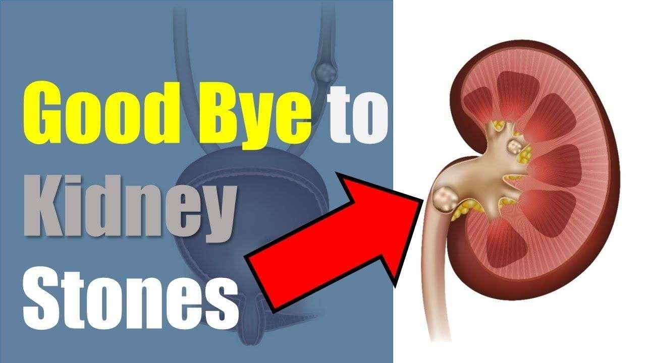 Say Good Bye to Kidney Stones in a Few days. Natural Home ...