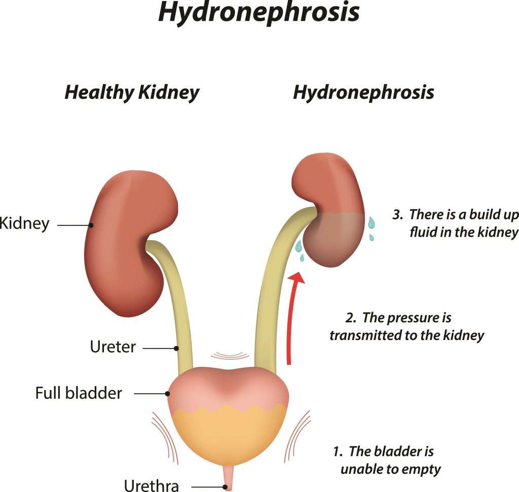 what-does-a-cyst-on-your-kidney-mean-healthykidneyclub