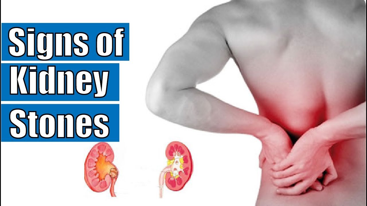Signs of kidney stones