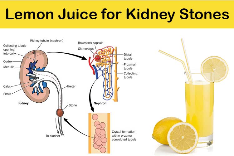 Simple &  Easy Steps to Dissolve Kidney Stones with Lemon ...